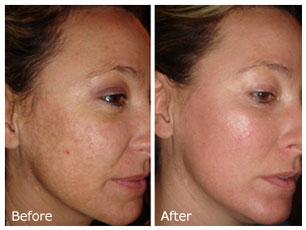 chemical-peel---before-and-after